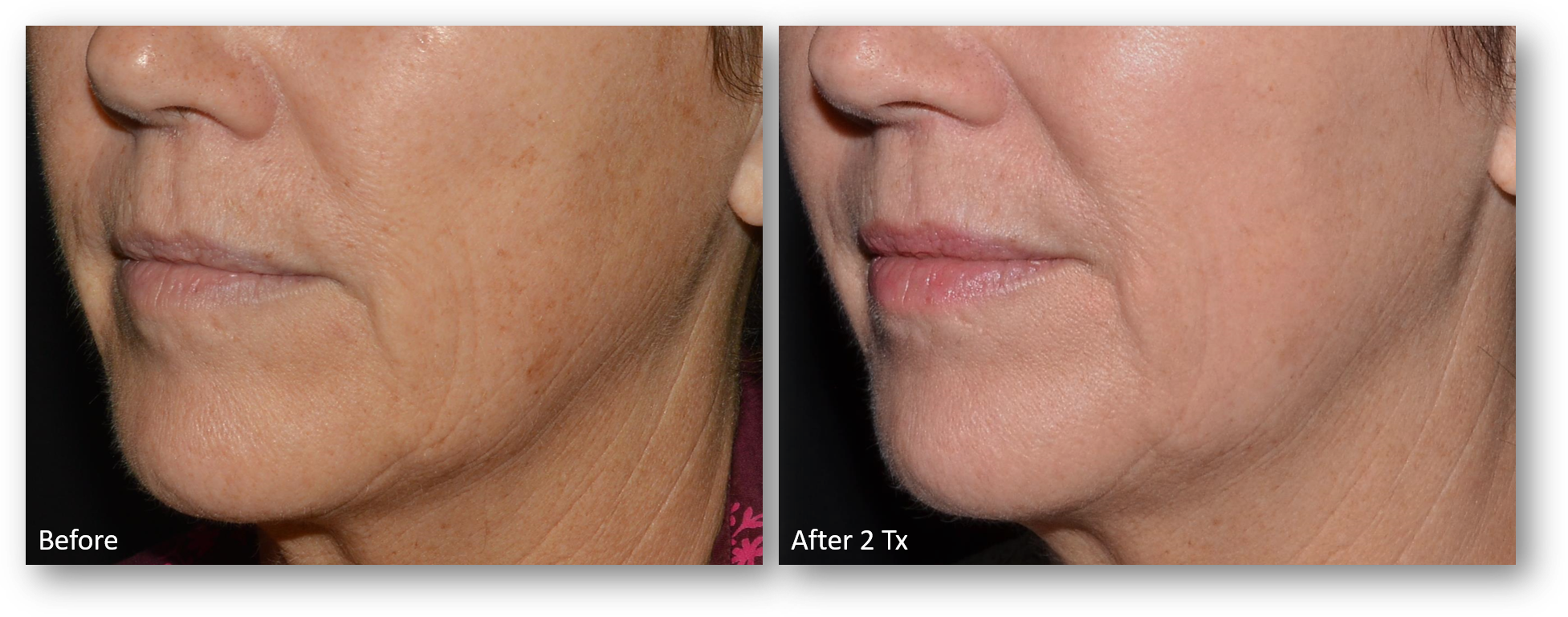 LaseMD Ultra before and after result 5