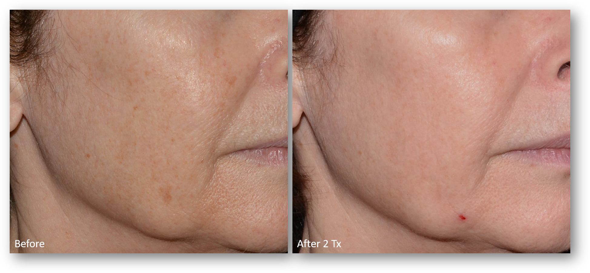 LaseMD Ultra before and after result 3