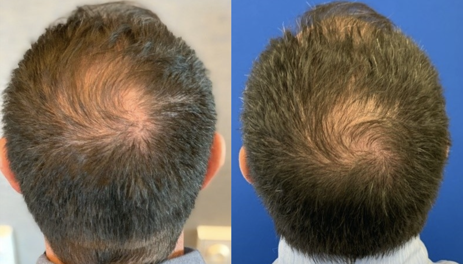 Hair loss treatment before and after - patient 1