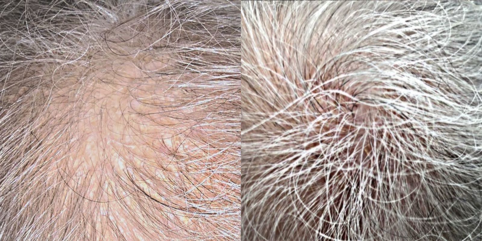Hair loss treatment before and after - patient 4
