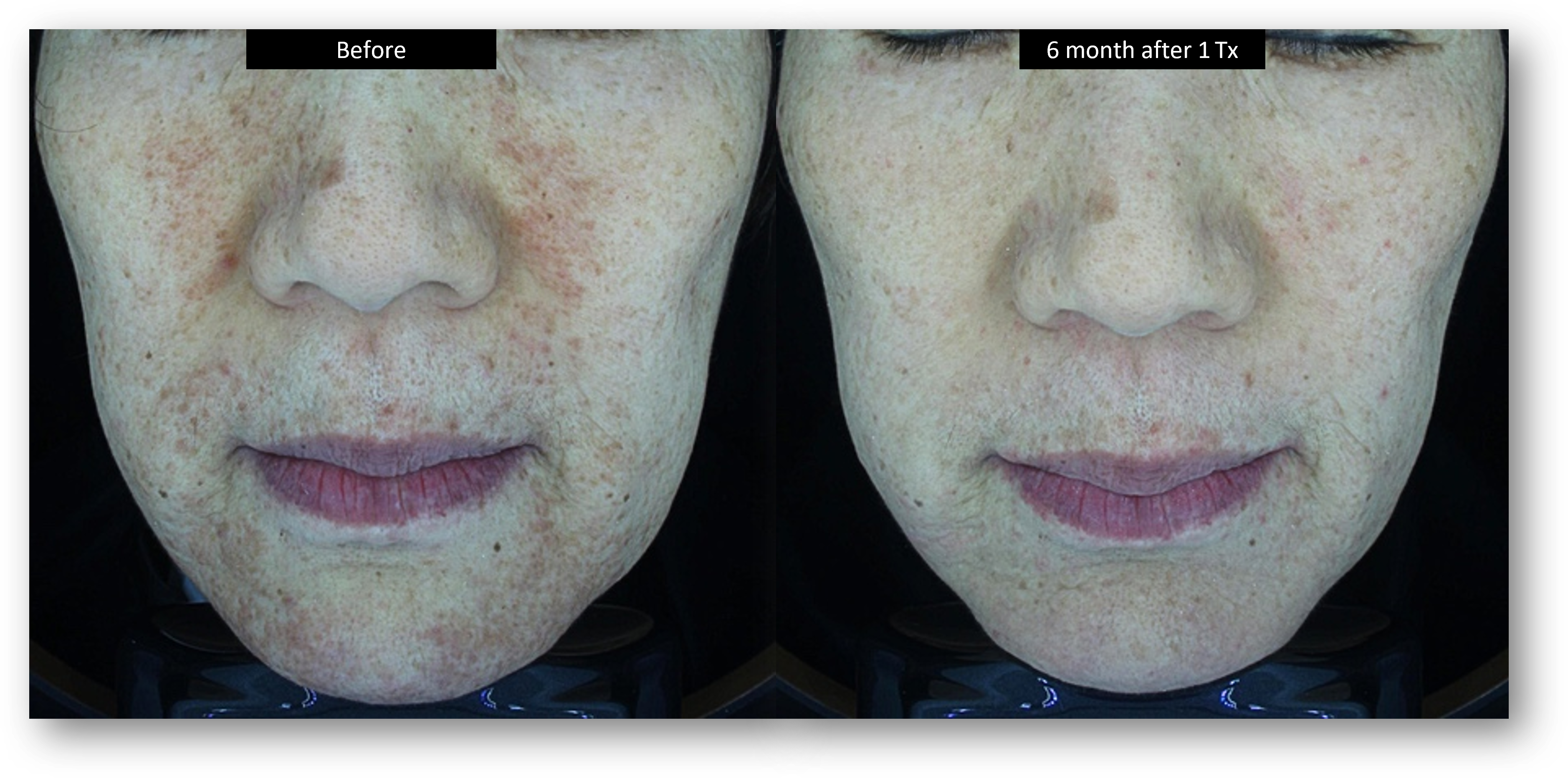 DermaV Laser before and after result 4