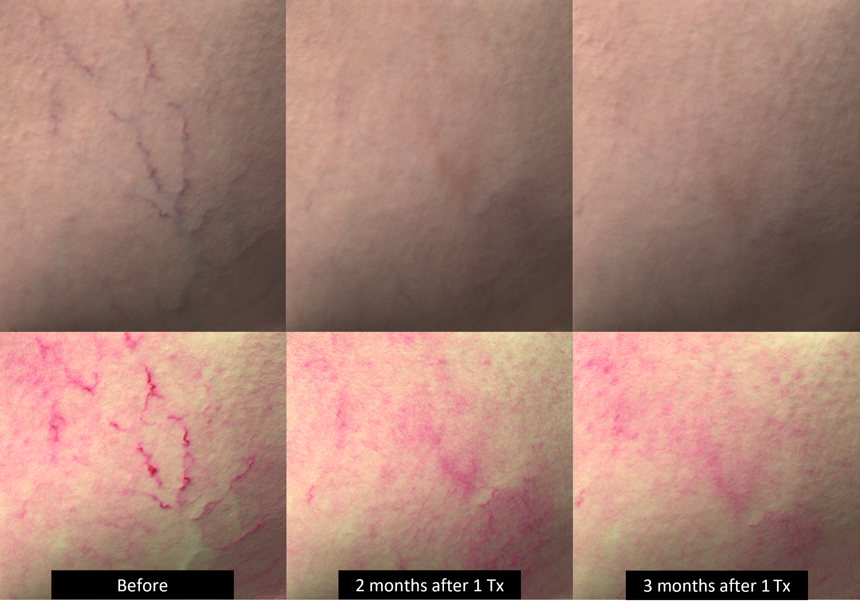 DermaV Laser before and after result 5