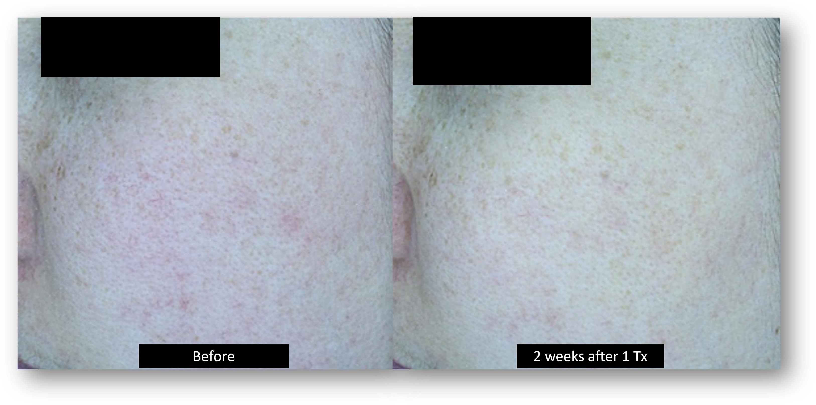 DermaV Laser before and after result 10