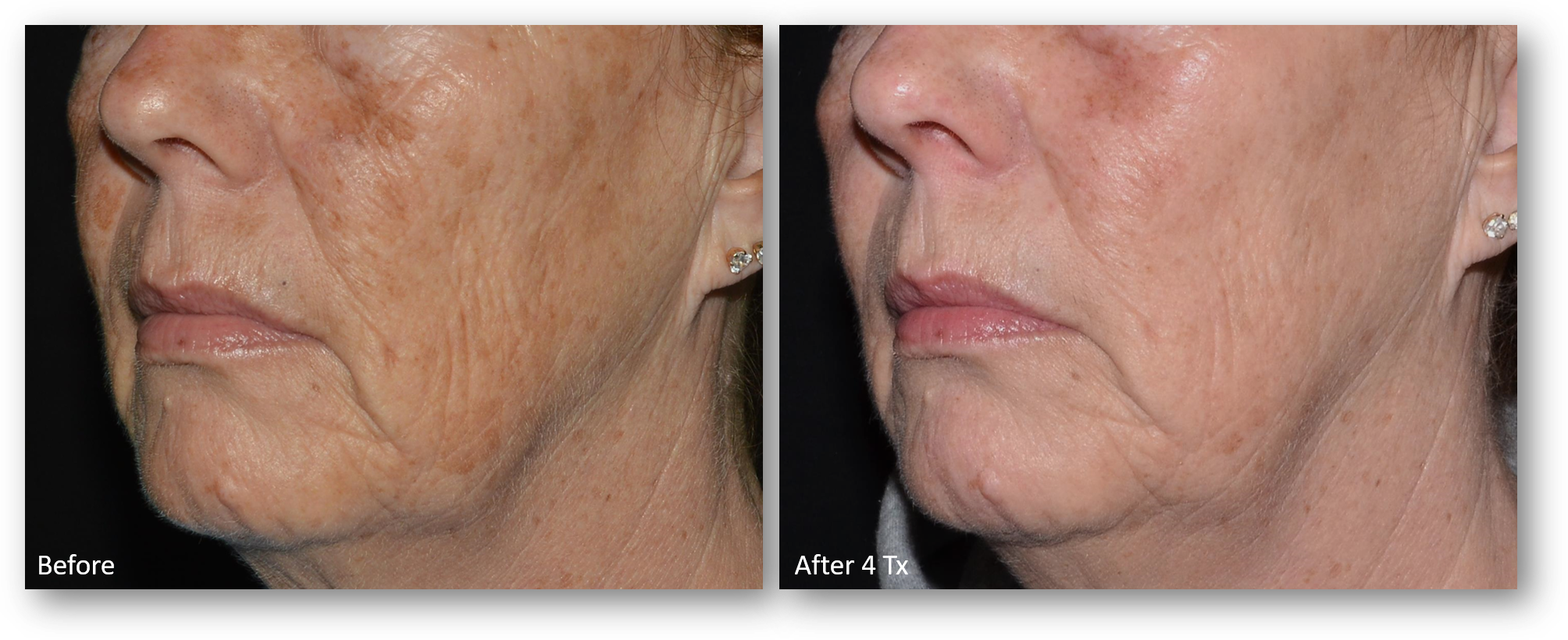 LaseMD Ultra before and after result 15