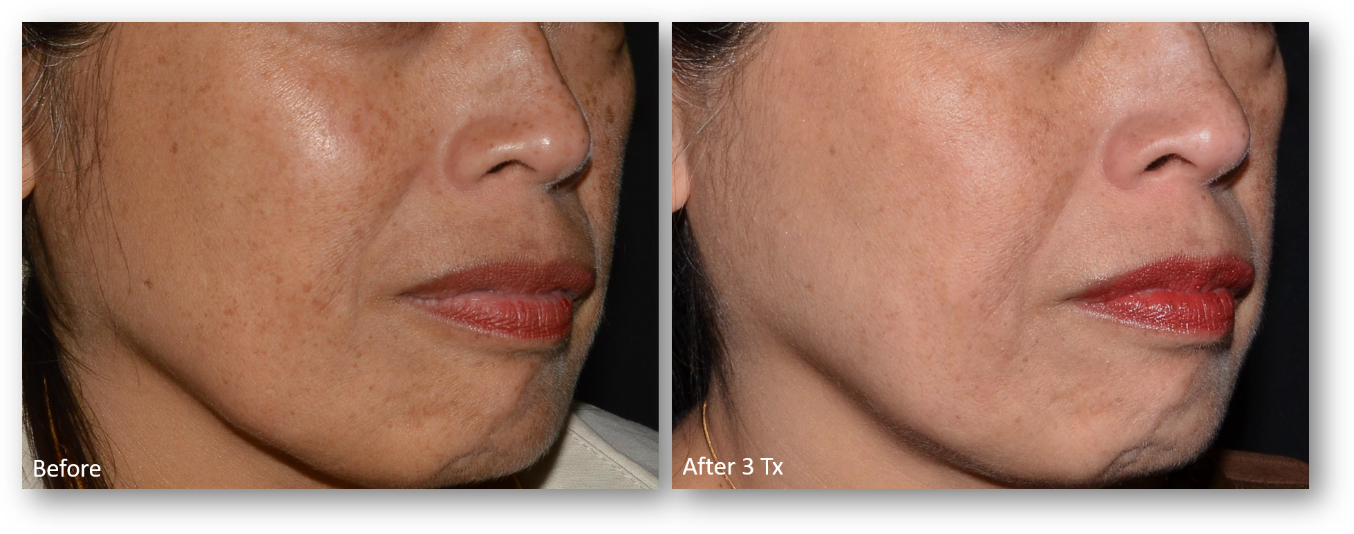 LaseMD Ultra before and after result 8