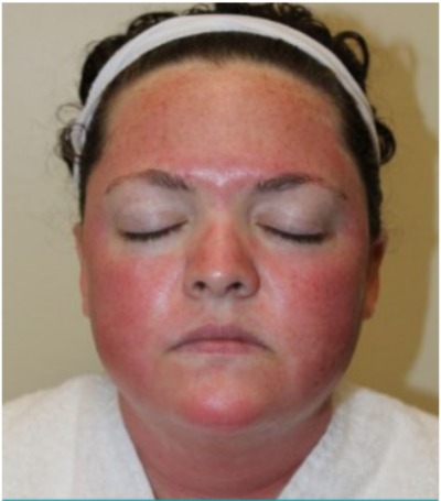 Microneedling 1 Hour After at Sergay Dermatology