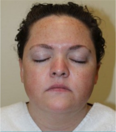 Microneedling 24 Hours After at Sergay Dermatology