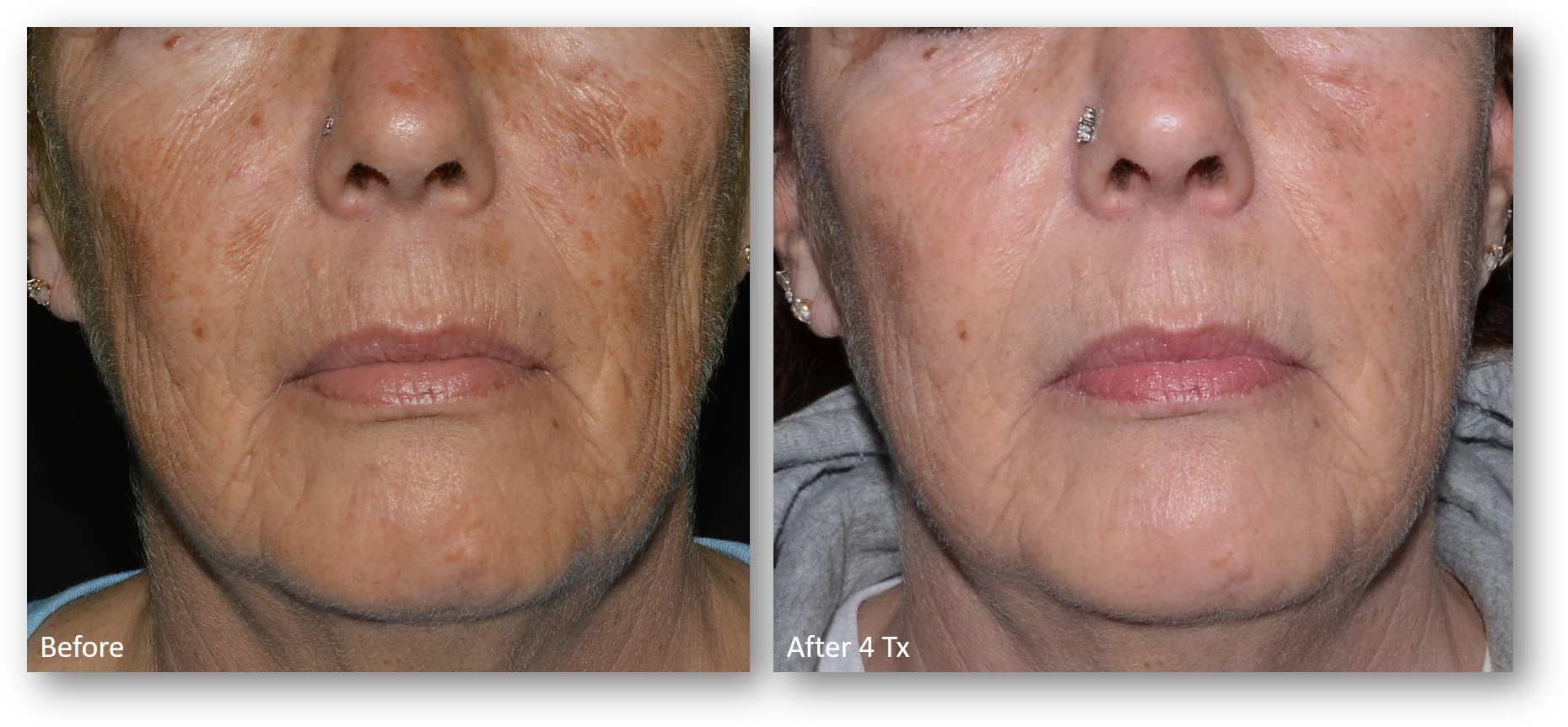 LaseMD Ultra before and after result 14