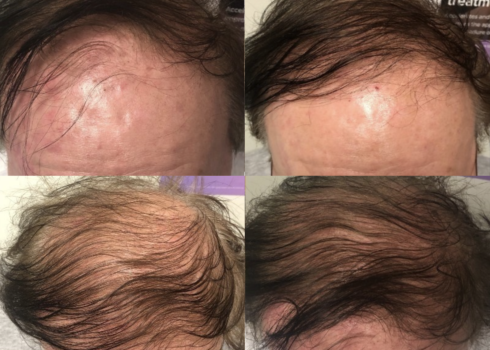 Hair loss treatment before and after - patient 2