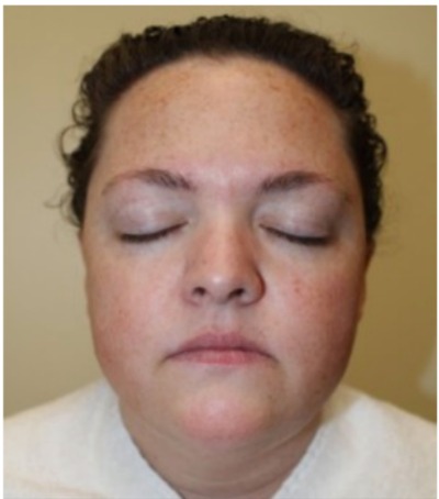 Microneedling Before at Sergay Dermatology