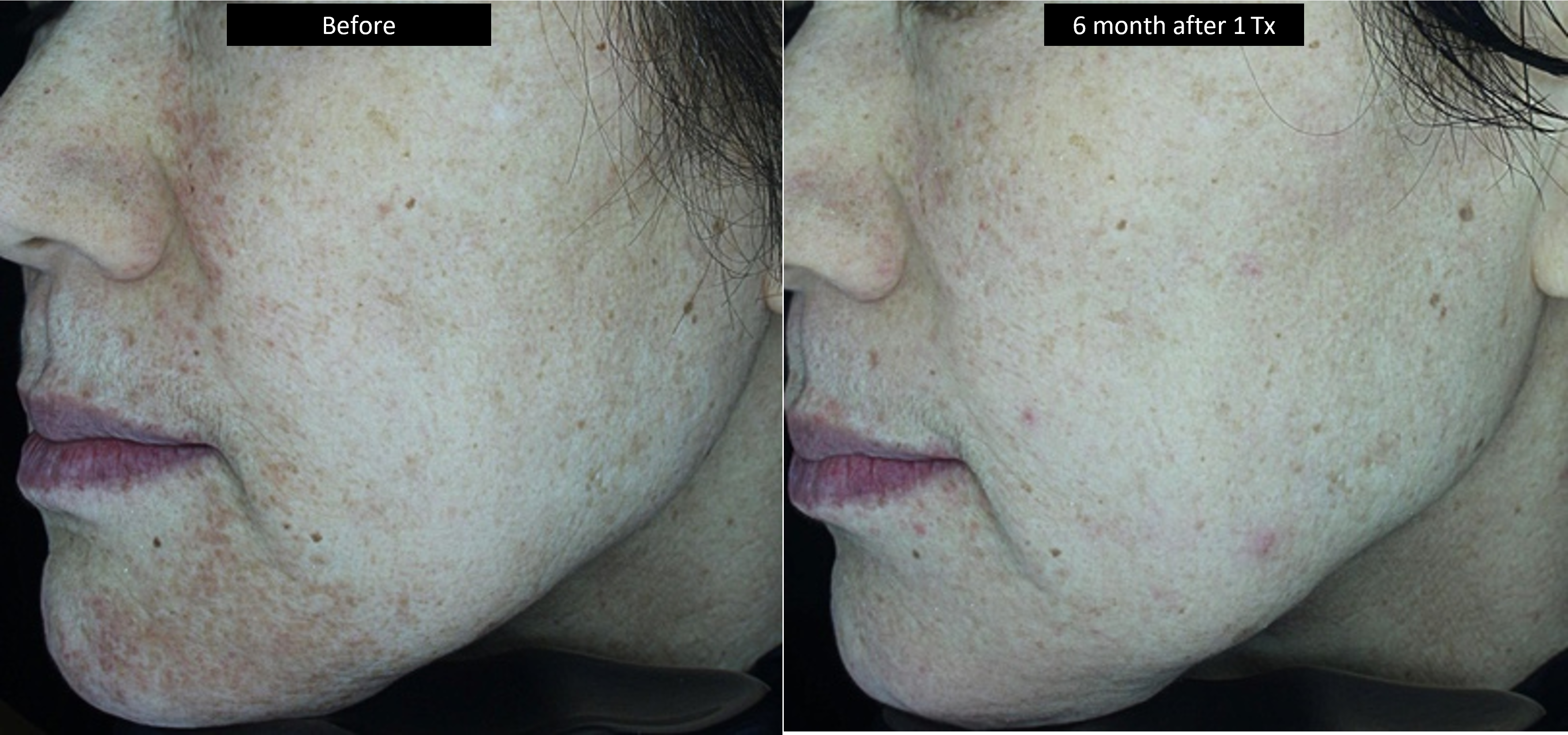DermaV Laser before and after result 2
