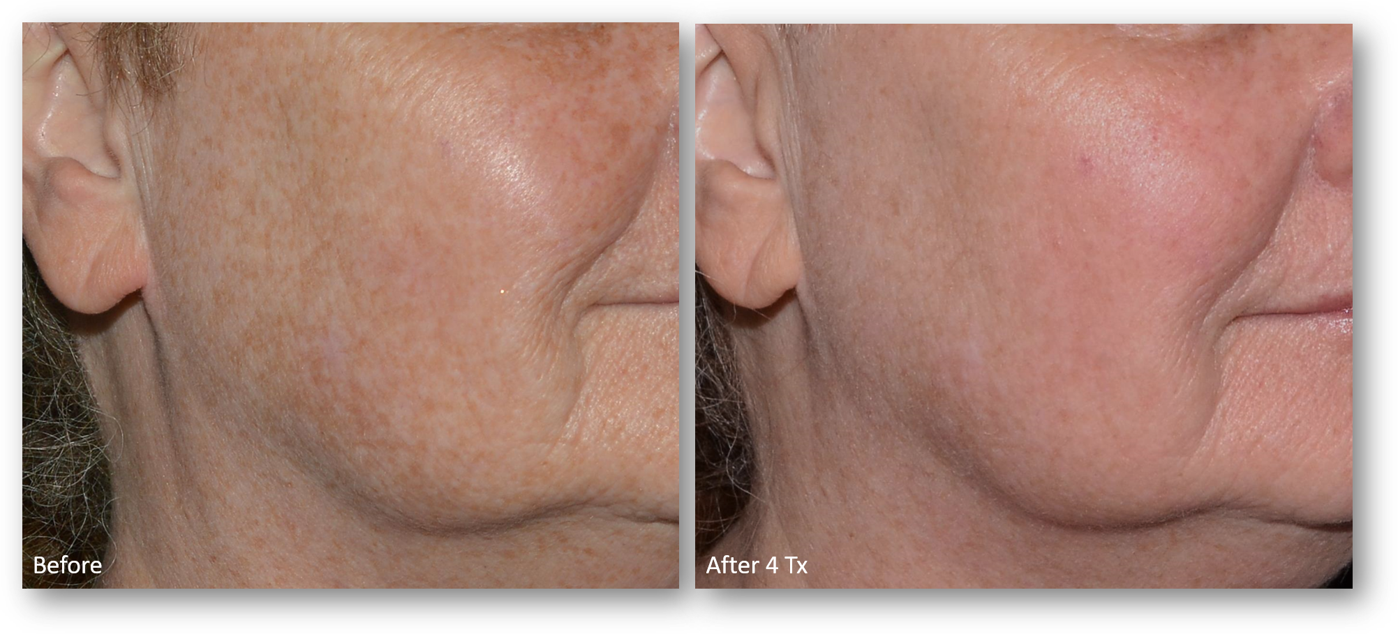 LaseMD Ultra before and after result 10