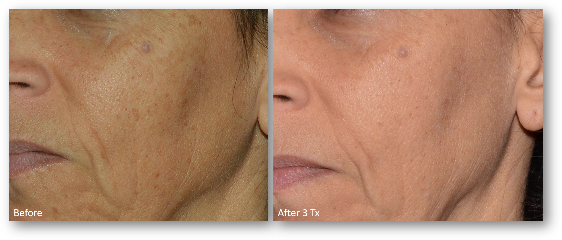 LaseMD Ultra before and after result 1