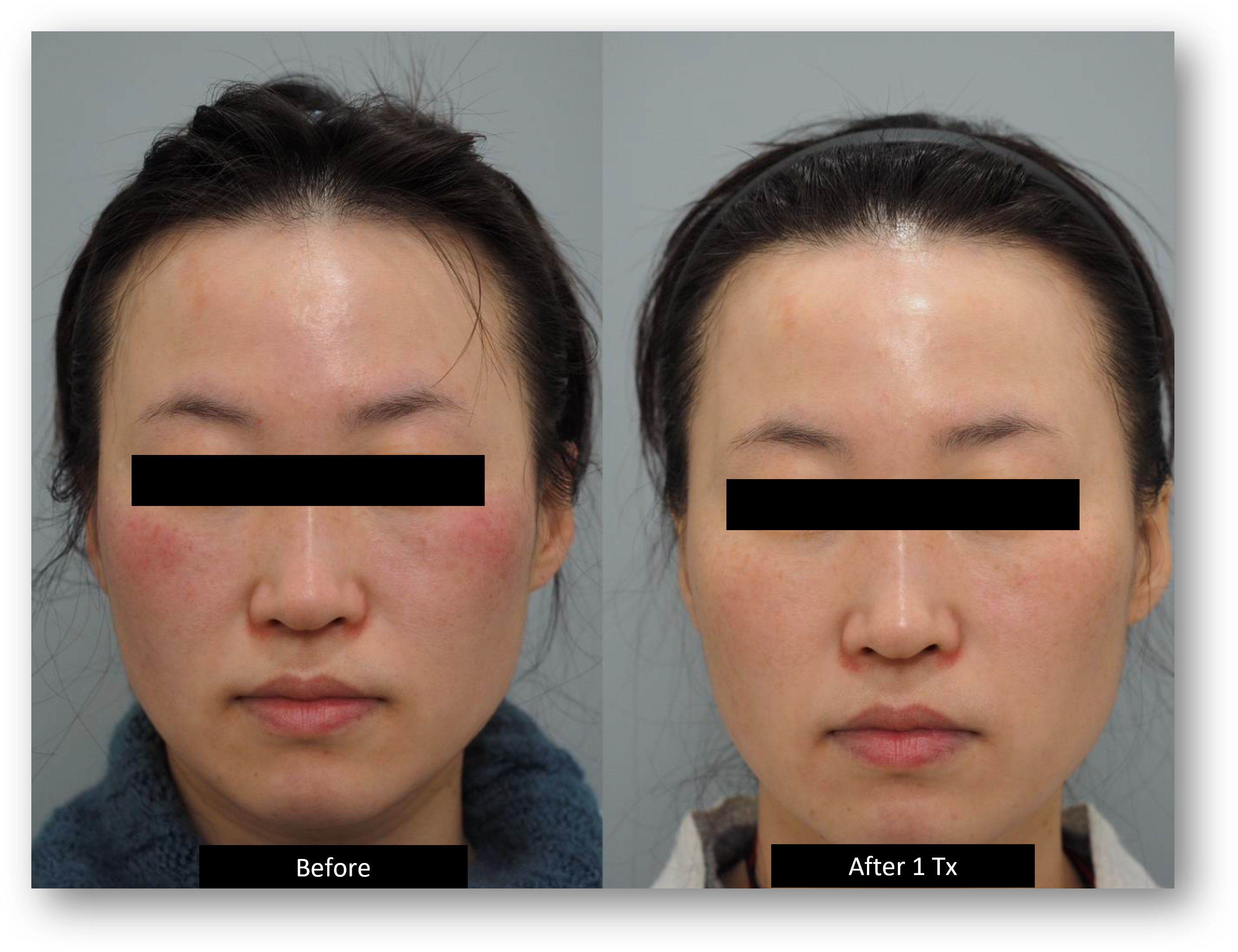 DermaV Laser before and after result 9