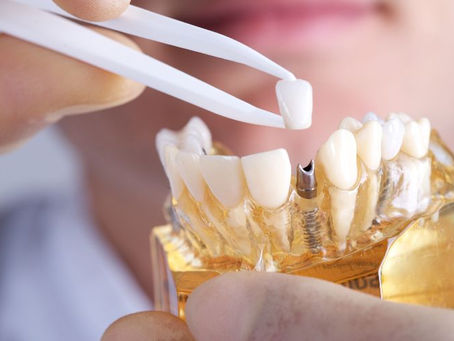 Renew Your Smile: Experience the Transformation with Dental Implants