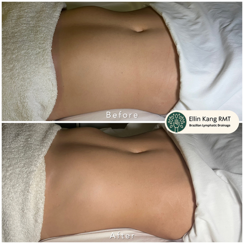 Body lymphatic drainage