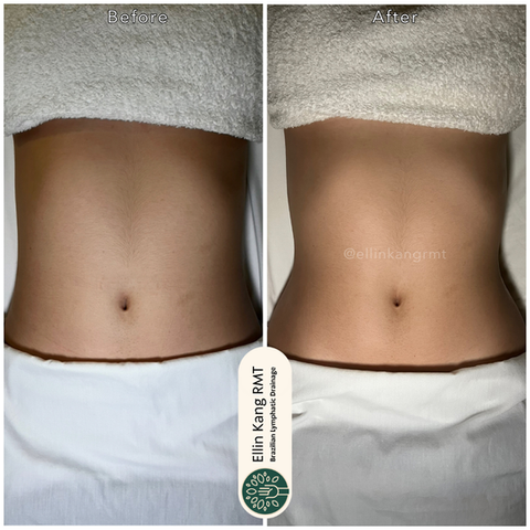 Body lymphatic drainage