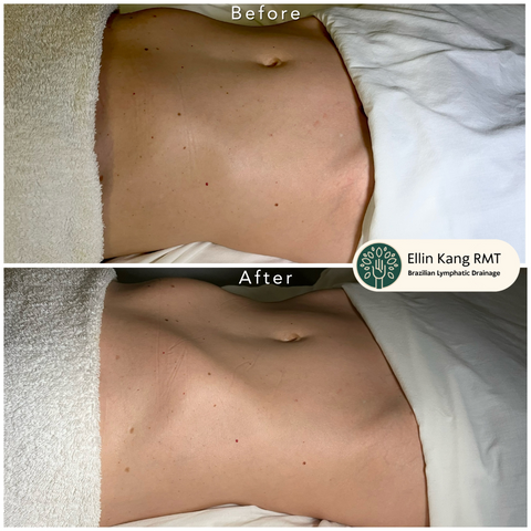 Body lymphatic drainage