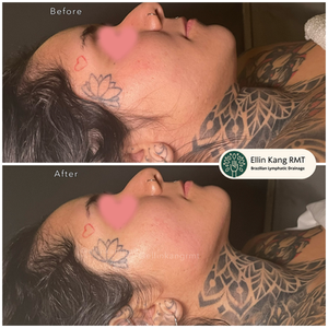 Lymphatic drainage massage