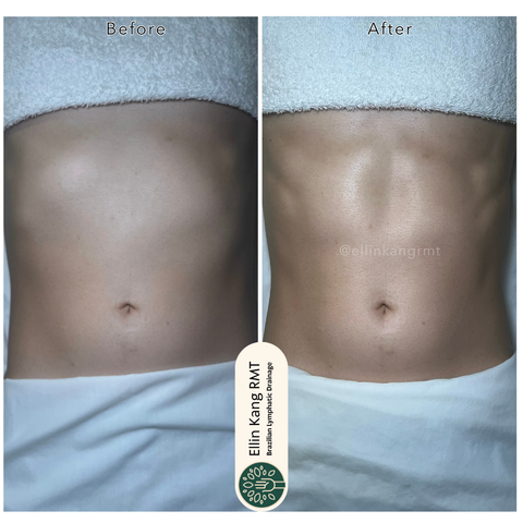 Body lymphatic drainage
