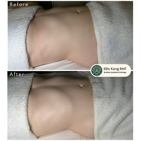 Body lymphatic drainage
