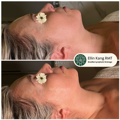 Face lymphatic drainage
