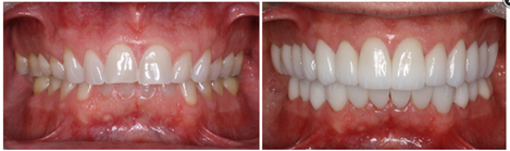 Full mouth IPS Empress Esthetic Crowns