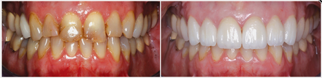 Full Mouth Zirconia Crowns with Layered Anterior 6-11"