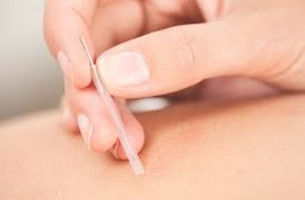 Patiënt die een dry needling behandeling ondergaat, waarbij dunne naalden worden gebruikt om triggerpoints in spieren te beha
