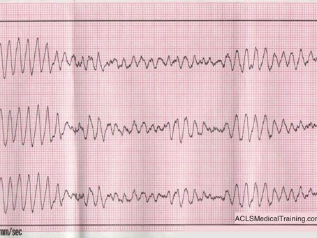 CPR First? Or Defibrillation First?