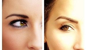 Open and lift your eyes with Body FX’s Botox brow lift in Houston, creating a naturally refreshed look without surgery.