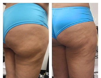 Before and after results from Body FX’s PCDC Fat Loss Shots in Houston, showing targeted fat reduction, smoother contours, and noticeable inch loss. Banana Roll Fat Loss in Just 2 Sessions