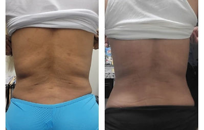 Visible transformation with Body FX PCDC Fat Loss Shots, demonstrating improved body shape, reduced stubborn fat, and a slimmer appearance. Back Bral Line Fat Loss in Just 2 Sessions