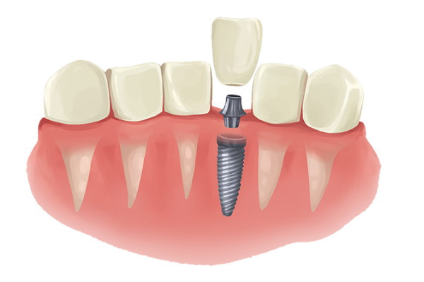 Implant Dentistry