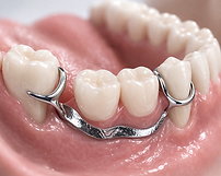 White Smiles | Removable Partial