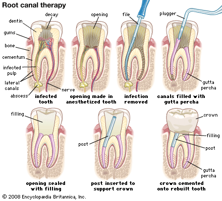 Root Canal Procedure