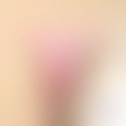 Urinary Incontinence Treatment in Women: Modern Solutions