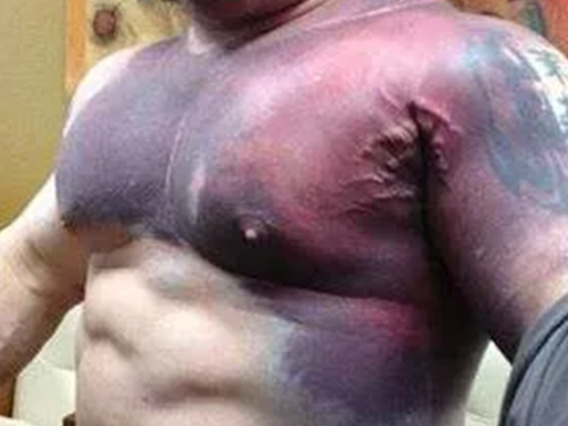 PECTORALIS MAJOR RUPTURE