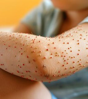 VIRAL SKIN INFECTIONS.jpg