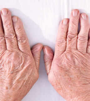 RHEUMATOID ARTHRITIS.jpg