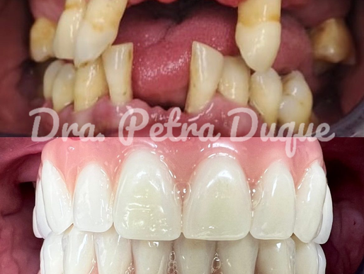 Implantes con Carga Inmadiata
