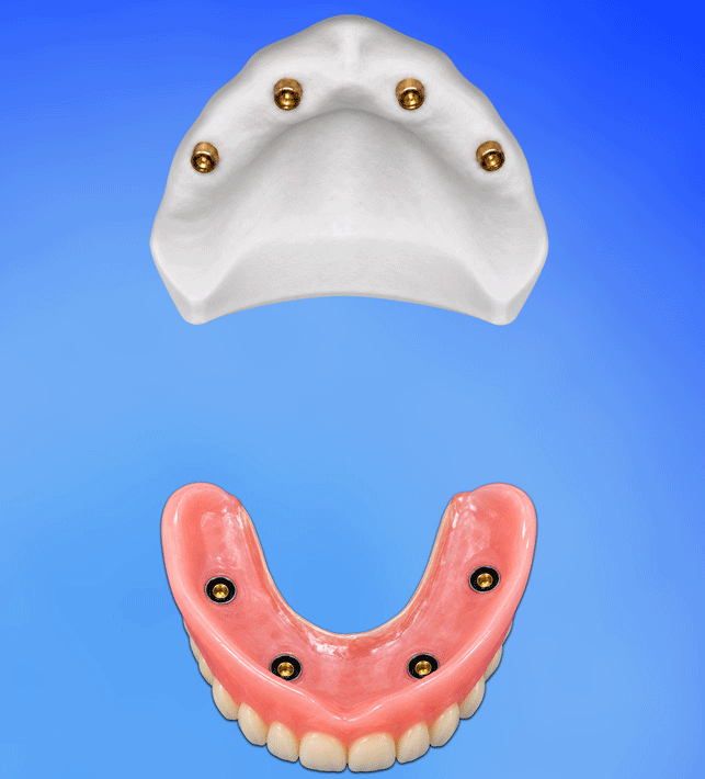 implant-overdenture-seatgif.gif