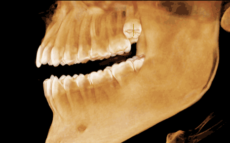 animated rotation of a cbct image