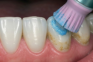 close-up of teeth getting polished