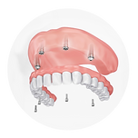 Dentures