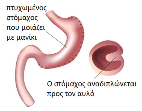 Αποτύπωση γαστρικής πτύχωσης