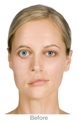 Woman who experienced Bell's Palsy, when a side of the face drops without muscle control