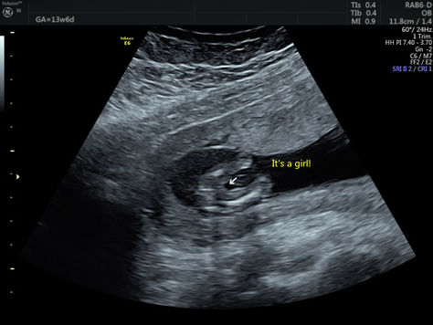 Essential Guide to 4D Gender Reveals at Tiny Hearts 4D Ultrasound in Clifton Texas