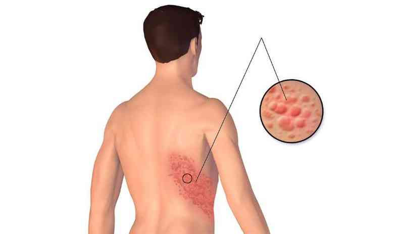 DOLOR EN EL HERPES ZÓSTER