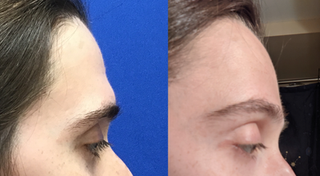 Forehead Lift, Hairline Lowering and Orbital Bony Contouring